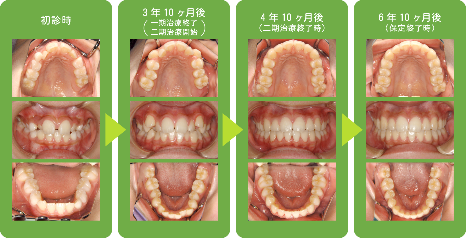 小児矯正