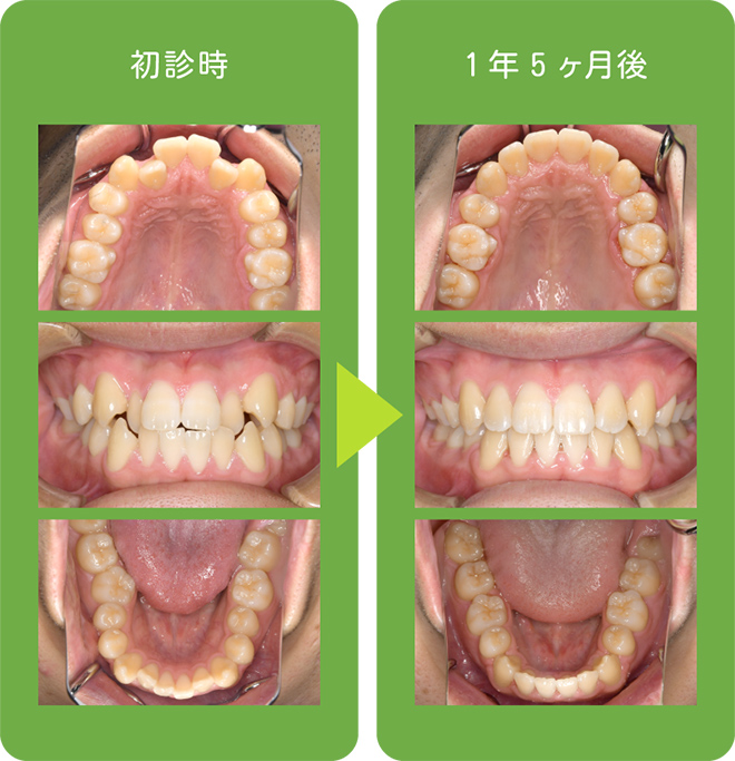 成人矯正