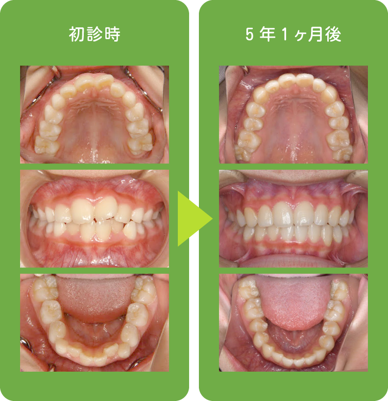 小児矯正